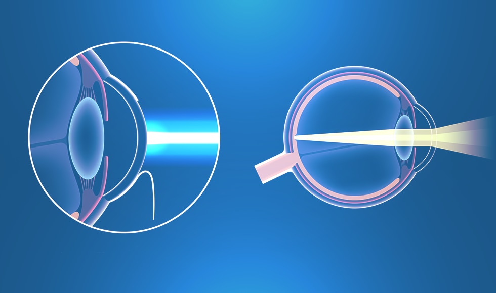 レーシックとは